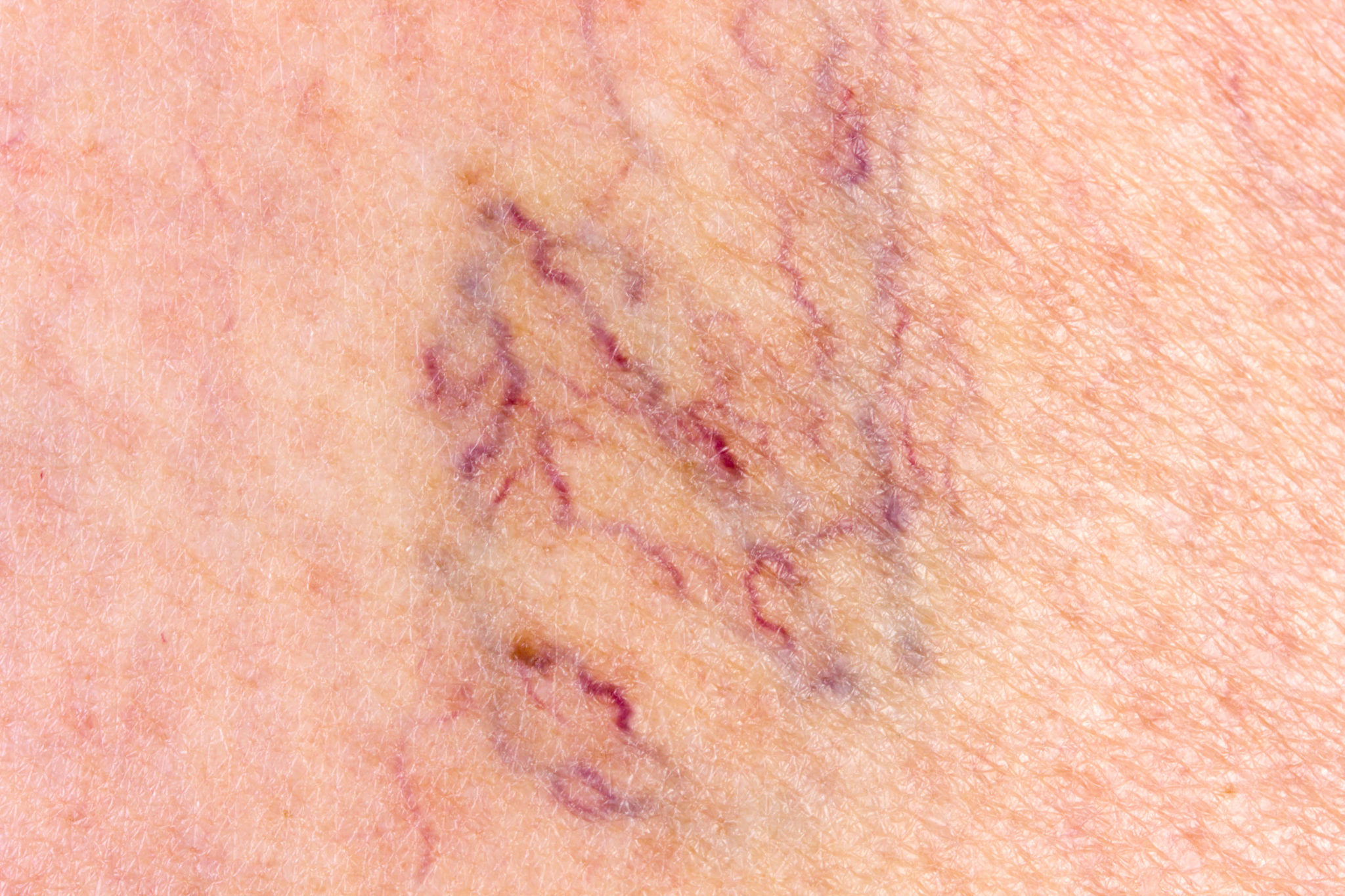 Close-up of leg with varicose veins