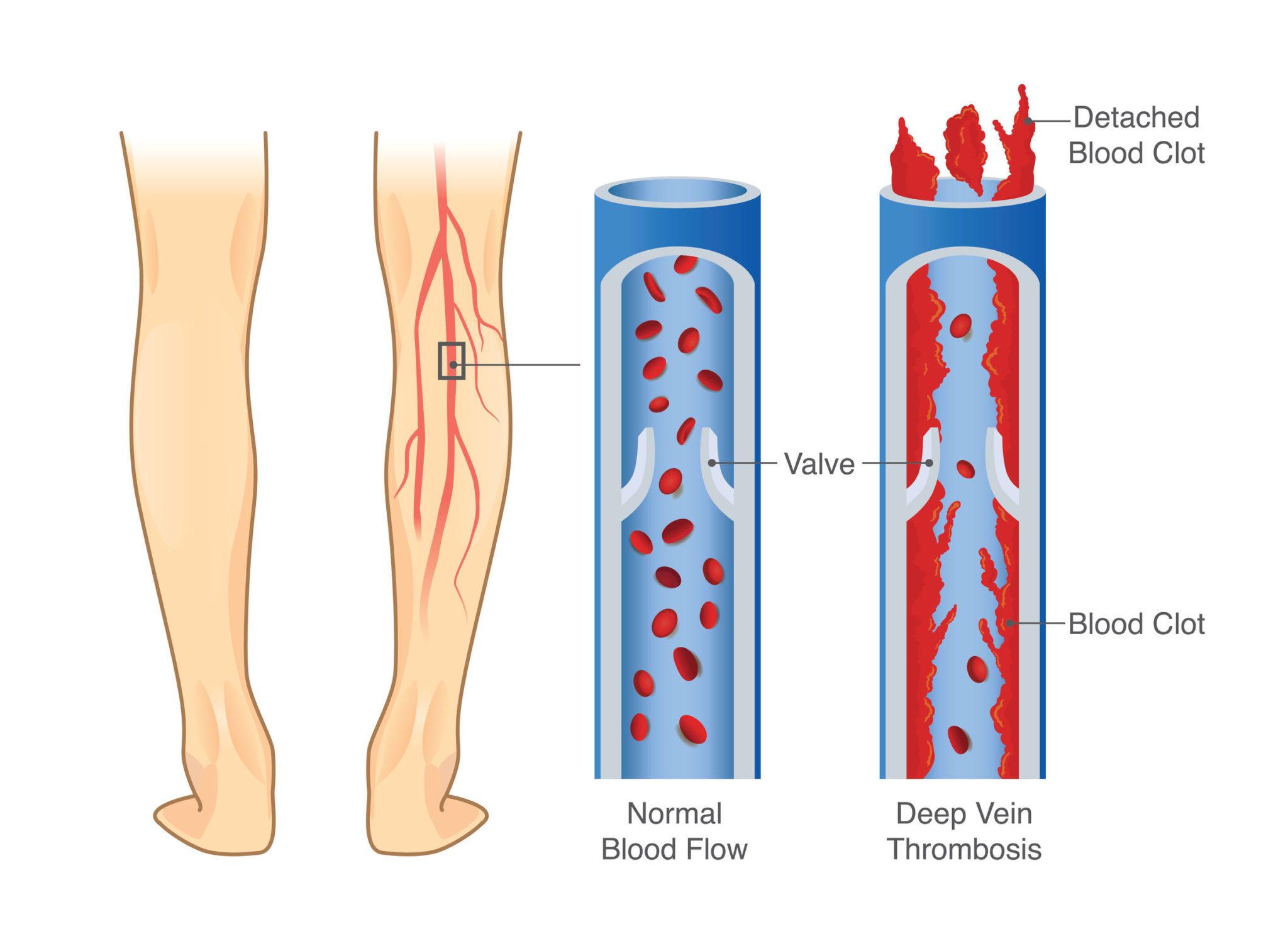medical diagram of deep vein thrombosis in leg area.