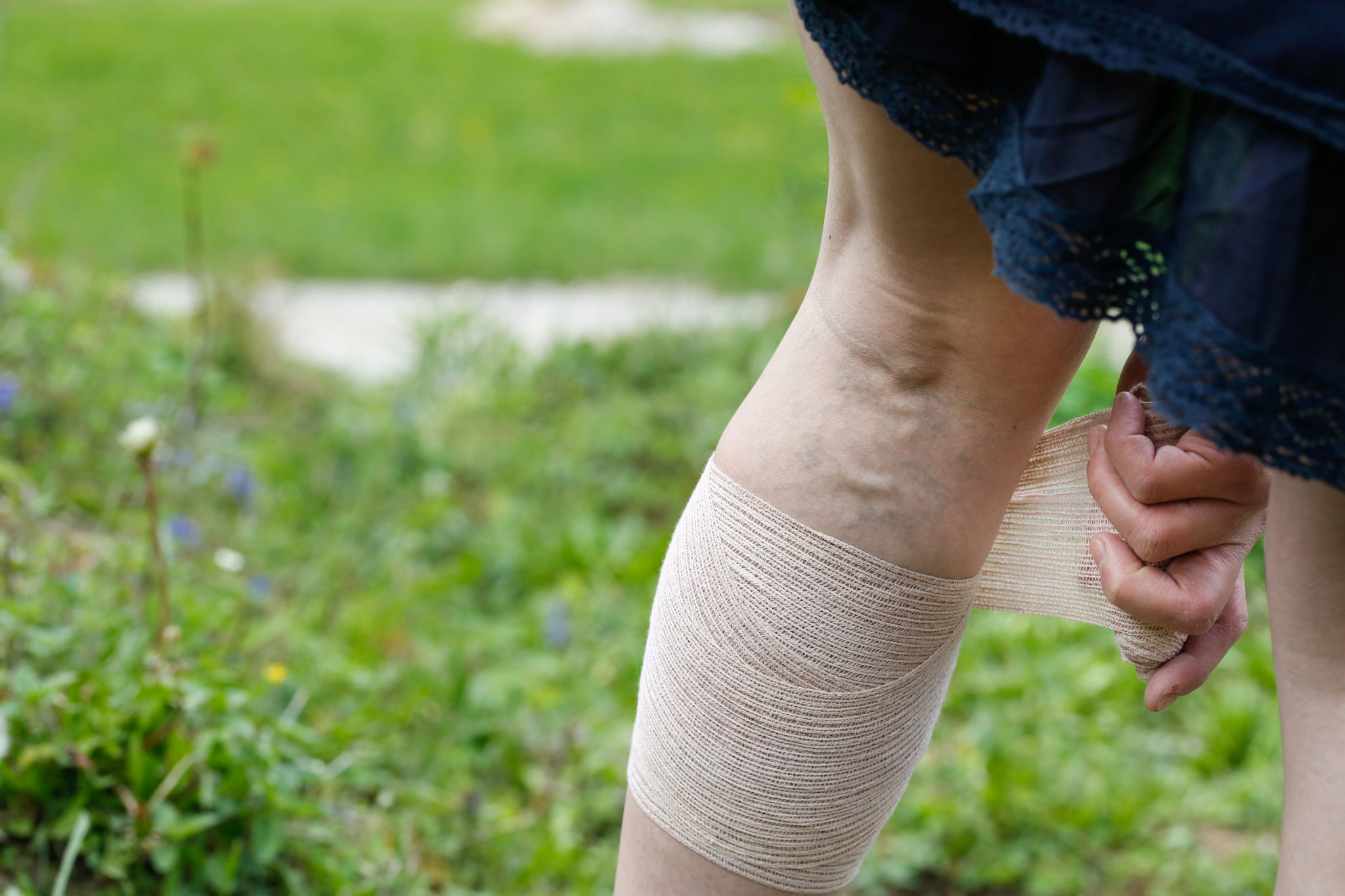 Woman with varicose veins applying compression bandage