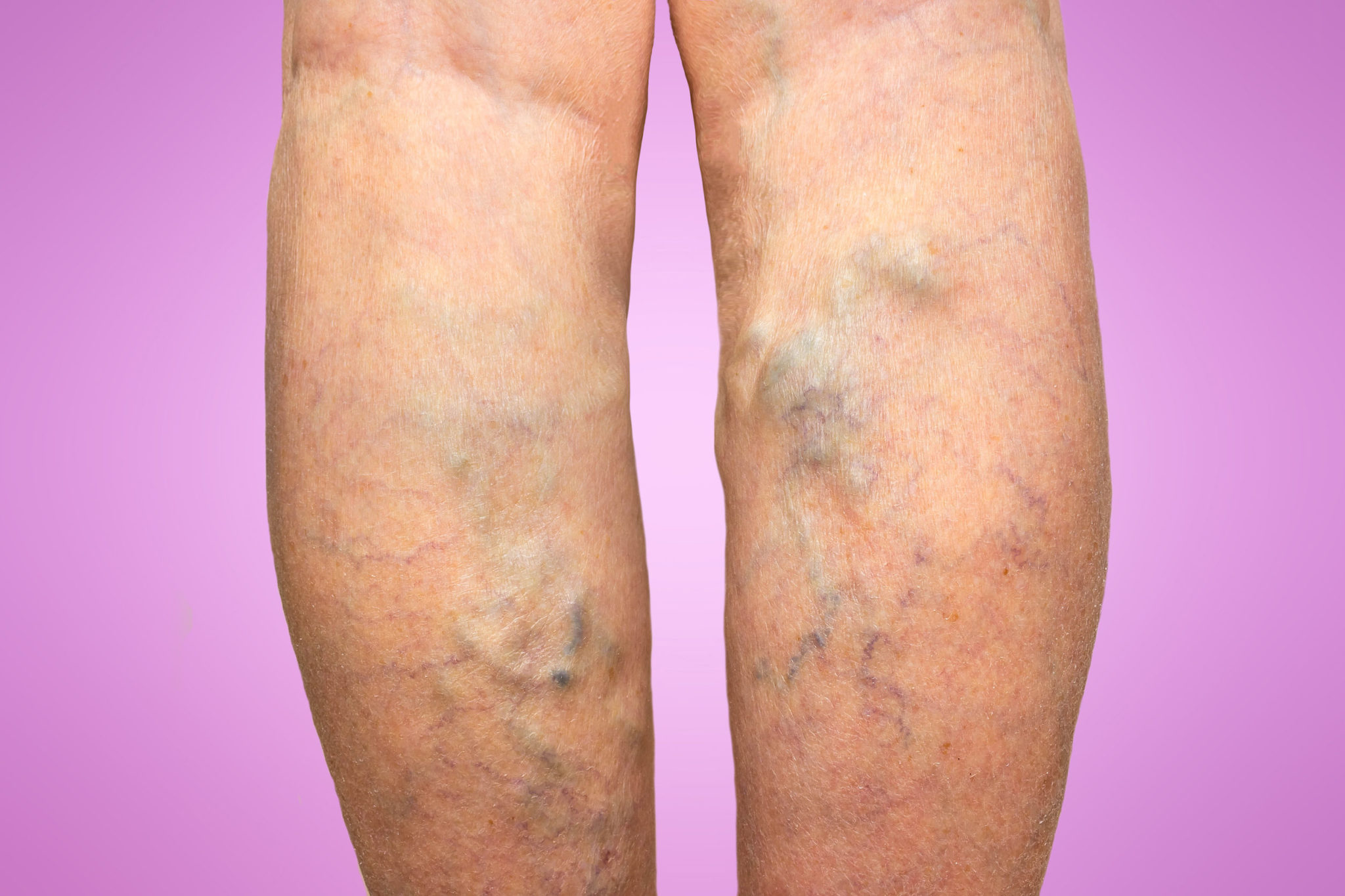 varicose veins on a female legs
