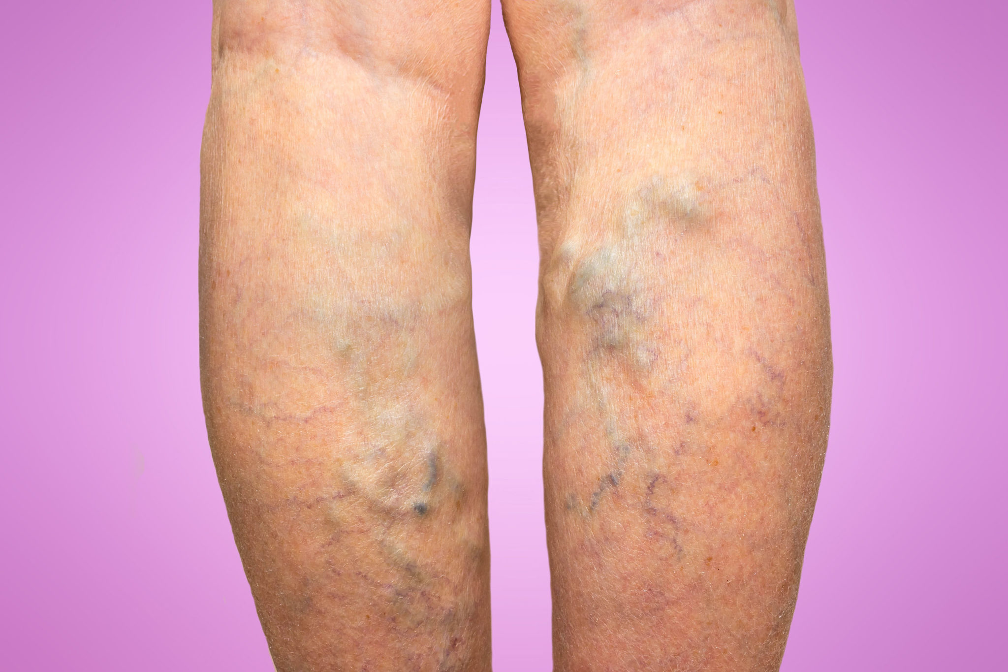 deep-vein-thrombosis