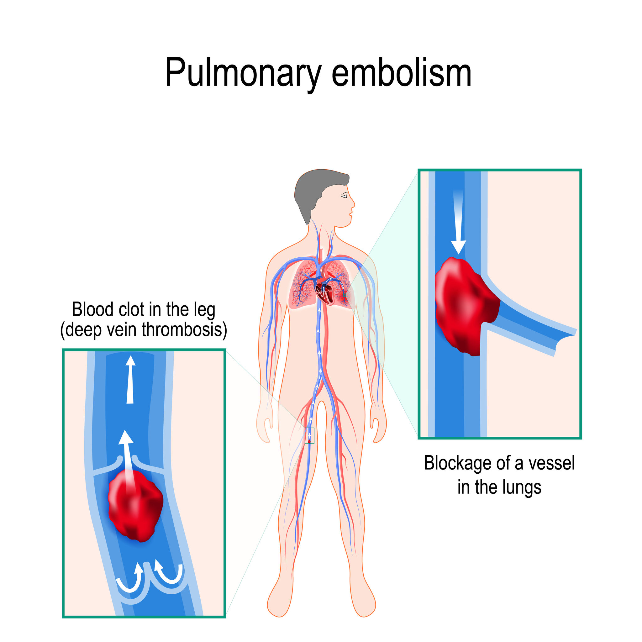 Pulmonary embolism. Human silhouette with highlighted circulator