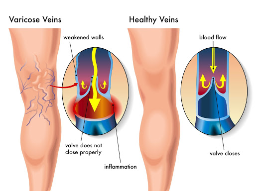 Venous Insufficiency and Venous Ulcers