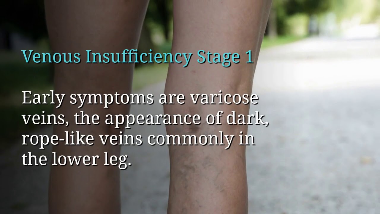 Venous Insufficiency, Stasis, and Ulceration