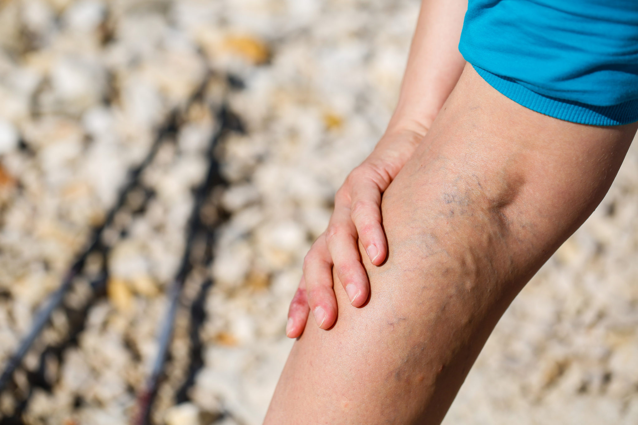 Woman touching painful varicose veins on a leg
