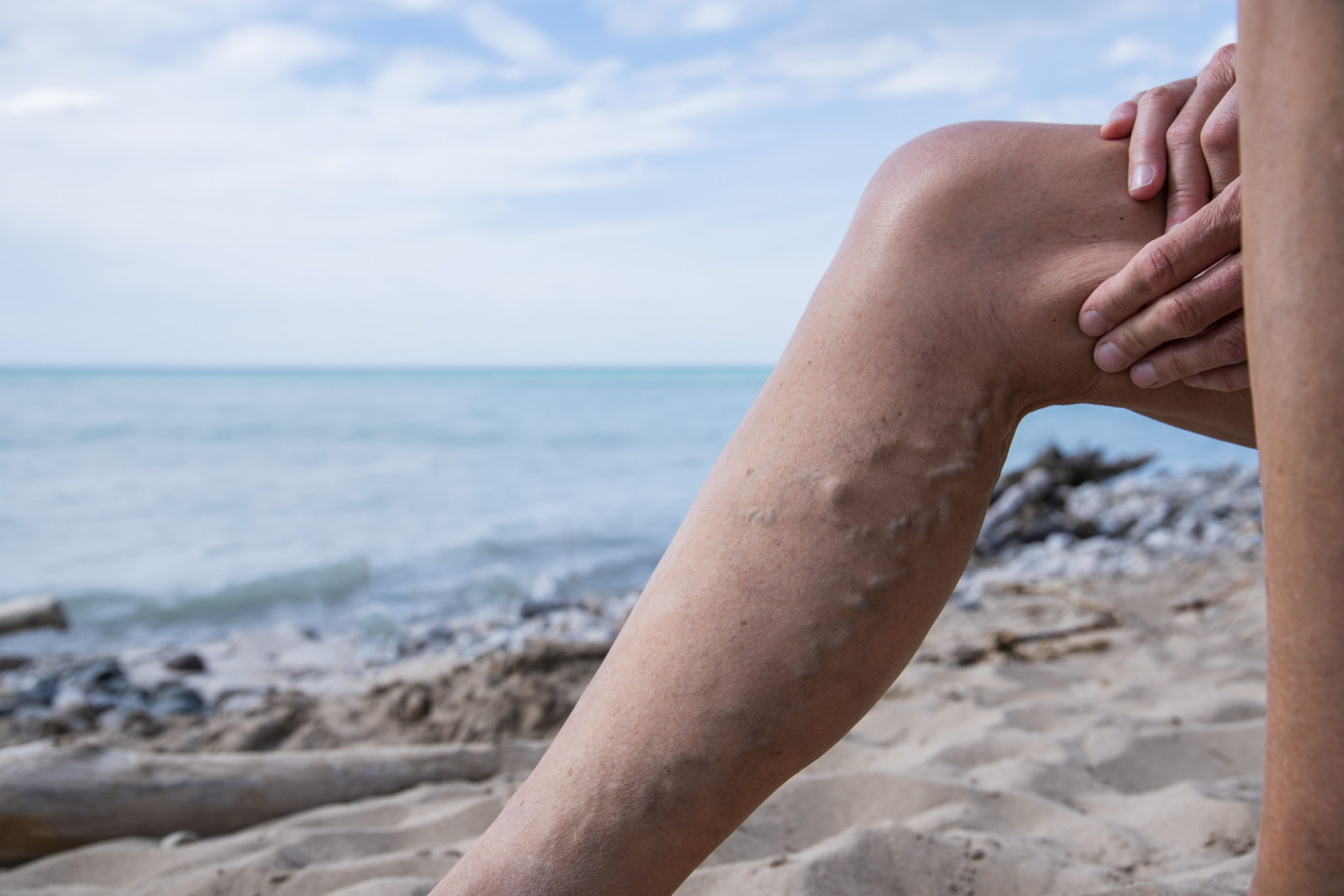A woman with varicose veins on the beach in the summer.