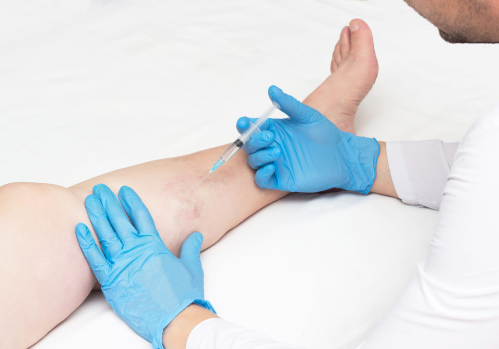 doctor-performs-sclerotherapy-for-varicose-veins-on-the-legs-varicose