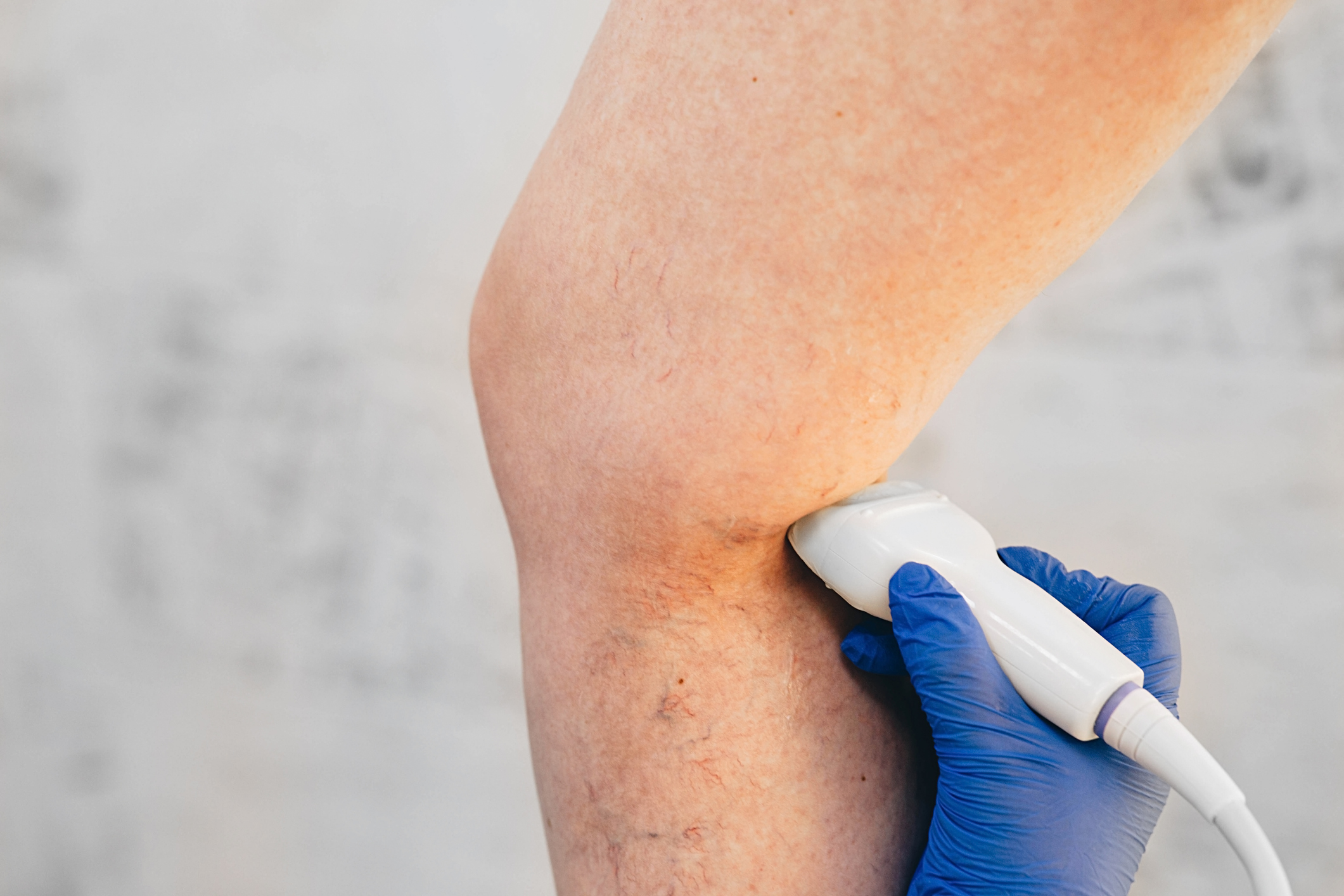 ultrasound exam veins on the leg