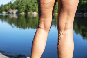 varicose veins